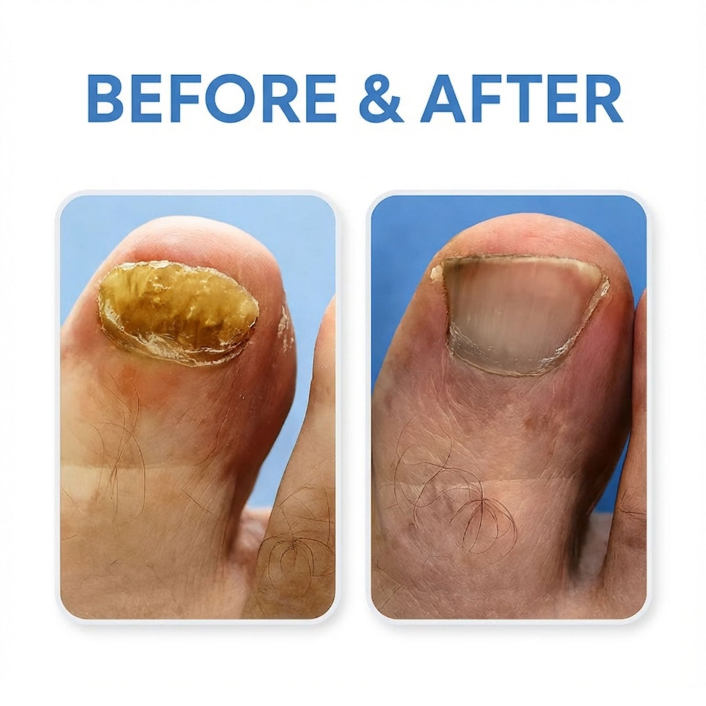 Inaafi™ Nail Antifungal Pen